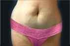 Miami Plastic Surgery Before & After Photos of  Real Patient's Tummy Tuck Procedure by Face+Body Cosmetic Surgery