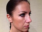 Before Photo of of Rhinoplasty Nose Job Surgery Patient