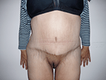 After Photo of Weight Loss Surgery Miami After Excess Weight Loss